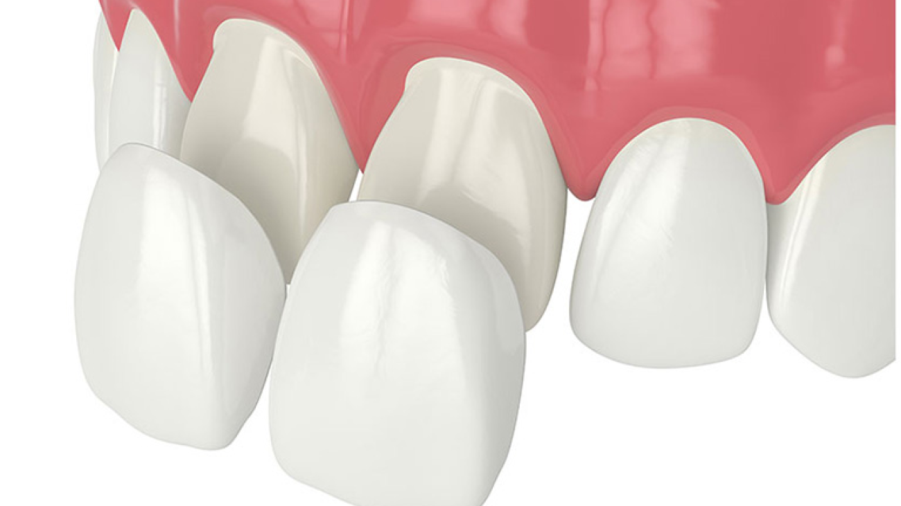 Dán Sứ Veneer – Giải Pháp Thẩm Mỹ Hoàn Hảo Cho Nụ Cười Tự Tin